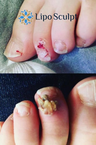 Wart removal customer results from Lipo Sculpt Lewes